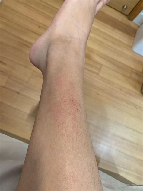 itchy rashes on my legs for over a week, what could it be? : r