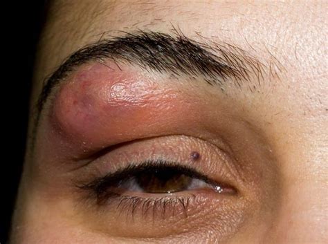 Furuncles and Carbuncles - Dermatologic Disorders - Merck Manual ...