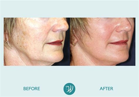 Indianapolis Skin Resurfacing Before & After Photos | Winslow Facial ...