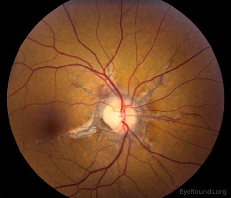 angioid streaks   retina