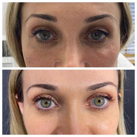 Facial Filler Before & Afters - The Aurora Skin Clinic