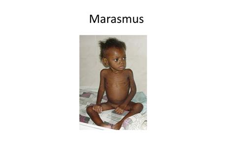 PPT - Nutritional Disorders PowerPoint Presentation, free download - ID ...