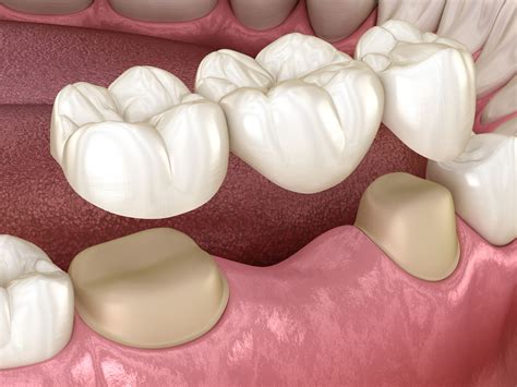 teeth bridge work 5