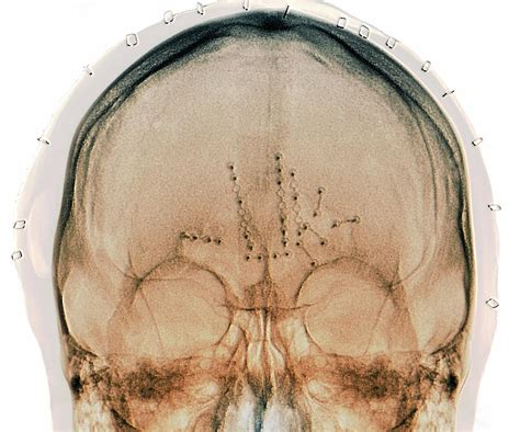 fixed skull fractures  road accident  photograph  zephyr