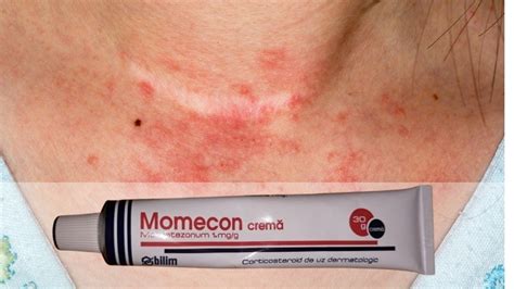 What Is Momecon Cream Used For? What are the Side Effects? - Fitness ...