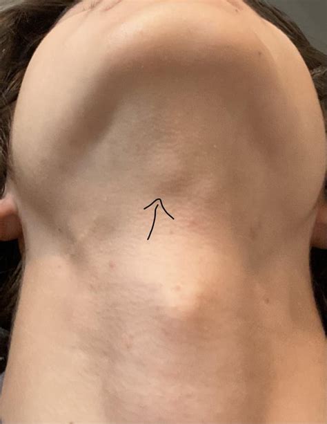 Small lump under chin above adams apple : r/medical