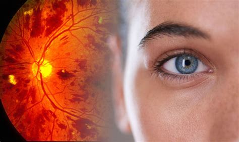 Eye cancer symptoms: Warning signs of the deadly disease including ...