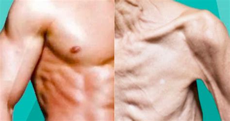 Unveiling the Secrets of Disuse Syndrome: How Inactivity Impacts Aging