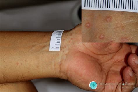 liquen plano dermatologia  saude