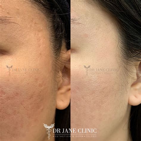 Acne Scar Laser Treatment: Pico VS CO2 Laser