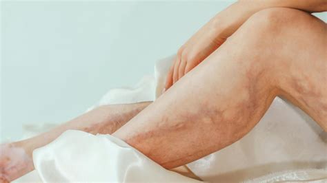 penyebab terjadinya varises   mengobatinya  benar merahputih