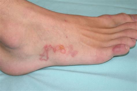 Hookworms in Humans: Signs, Transmission, Prevention