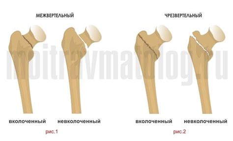 Вертельный перелом бедра (бедренной кости): симптомы, признаки, лечение ...