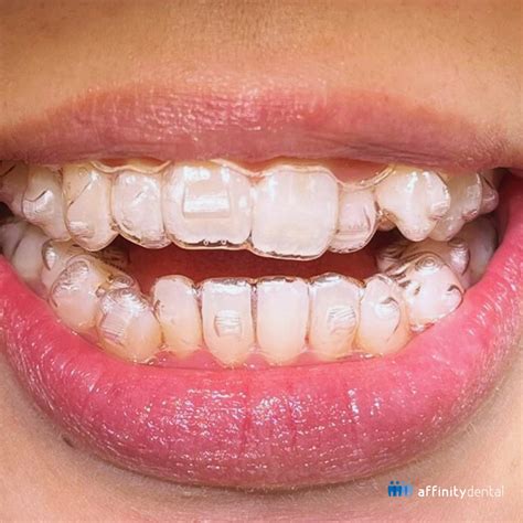 types  braces invisalign metal  ligating lingual braces