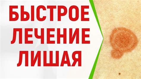 Быстрое лечение лишая у человека в домашних условиях - YouTube