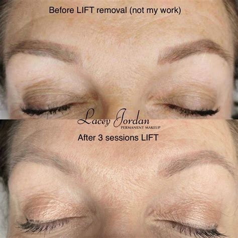 Tattoo Removal Surrey — Lacey Jordan