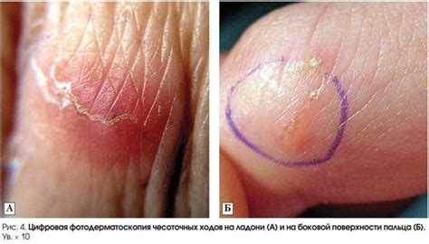 Чесотка: 3 главных признака, формы, симптомы и лечение — Медицинский ...