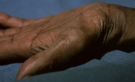 Thenar Muscle Atrophy | Hand Surgery Resource