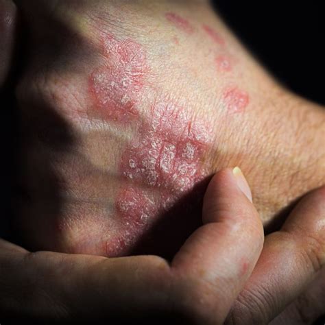 Finding Caring Hidradenitis Suppurativa Specialists | Treat ...