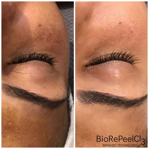 BioRePeel – Erneuere deine Haut bei Final Shape