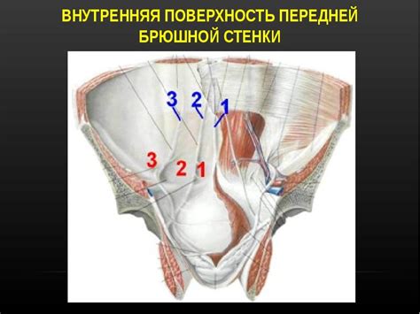 Паховая грыжа