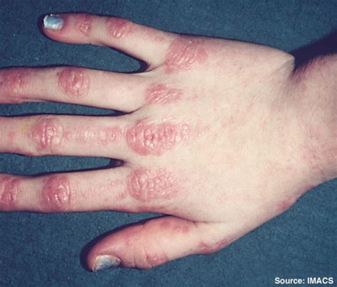 Dermatomyositis - dermRounds Dermatology Network