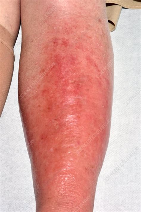 Cellulitis Upper Leg
