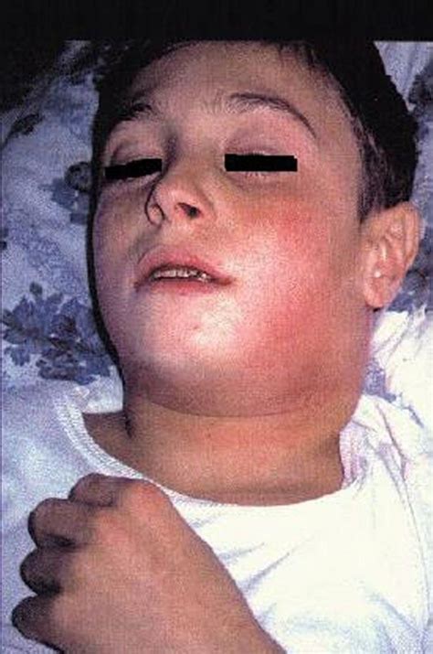 Image:Diphtheria (Nasopharyngeal With Bull Neck)-MSD Manual ...