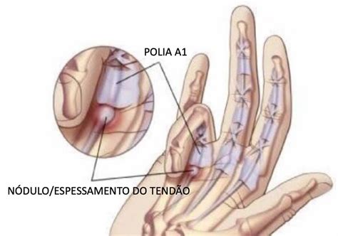 O Que É Dedo Em Gatilho - Dedo em Gatilho: sintomas e tratamentos