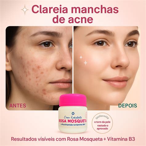 Melhor Creme Com Niacinamida - Creme Rosa Mosqueta com Niacinamida Clareador de Manchas de Acne e ...