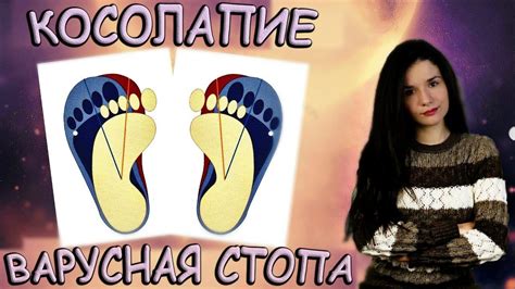 Косолапие / Варусная стопа - YouTube