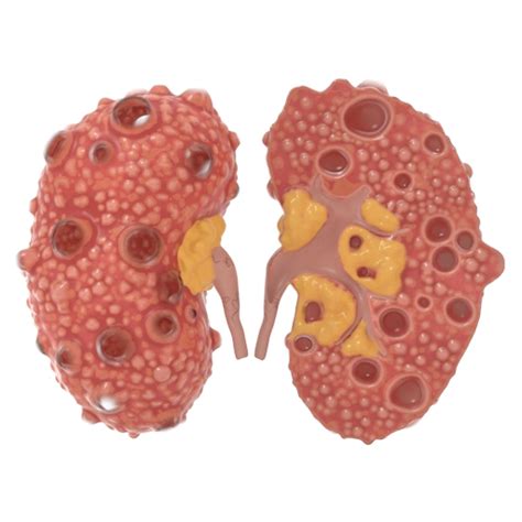 polycystic kidney disease treatment medilux ayurveda usa
