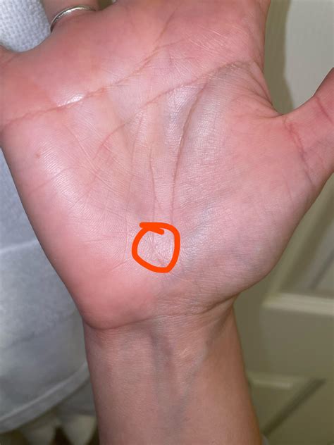 Warts? Dyshidrotic eczema? Not painful or itchy. Have had for several