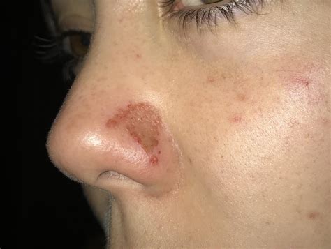 Scratches On Skin