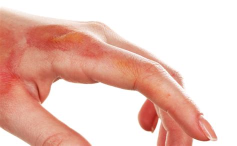 First Degree Burn