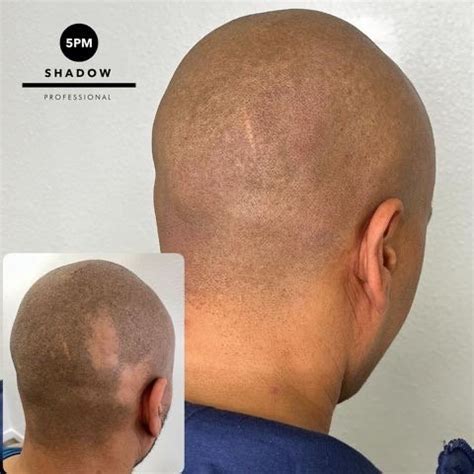 Alopecia Treatment in Orlando & Kissimmee | Hairline Studios