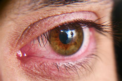 Patients with Graves' disease show high symptomatic rates of dry eye