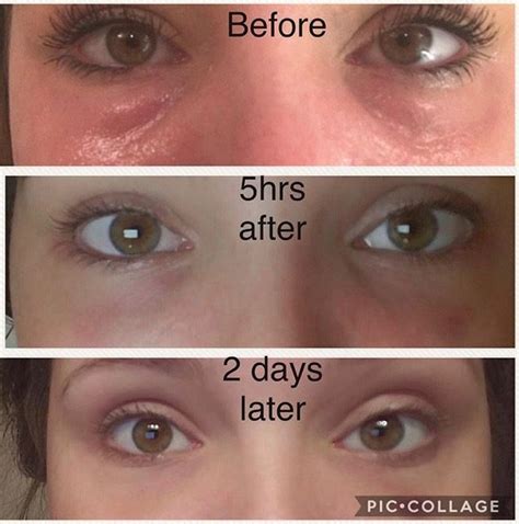 prp prf  eye treatment heres     beverly