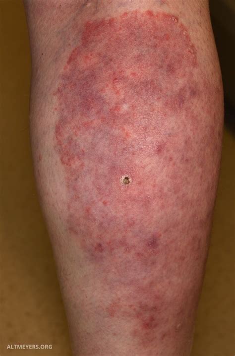 tinea corporis leg