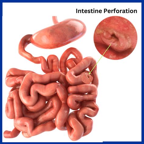 Small Intestine Disease - Kaizen Hospital | Small Bowel Disease
