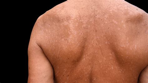 Tinea Versicolor Before And After