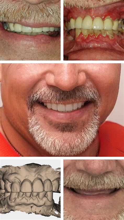 Dentures Towson, MD | Partial & Implant Denture Baltimore