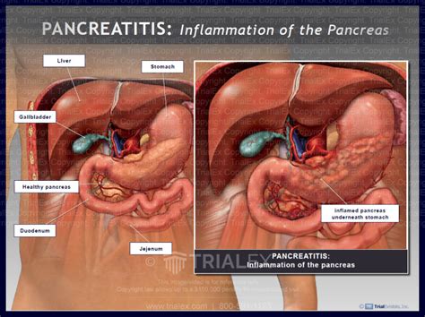 Pancreatitis: Inflammation of the pancreas - TrialExhibits Inc.