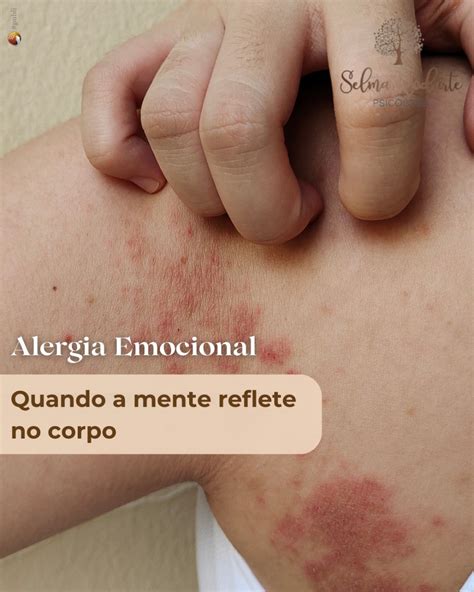 Dst Que Parece Alergia No Corpo - Portal Arcos - Alergia emocional: quando a mente reflete no corpo