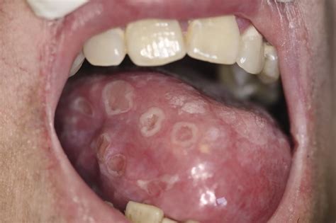 Sífilis en la cavidad oral: en los labios y la lengua: manifestaciones ...