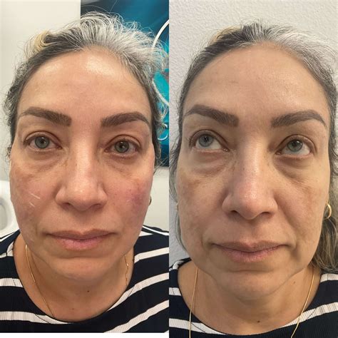 Antes y después - White Coat Med Spa