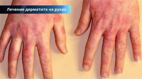 Кожный дерматит симптомы и лечение фото