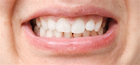 Misaligned Jaw – Symptoms, Causes and Treatment Options