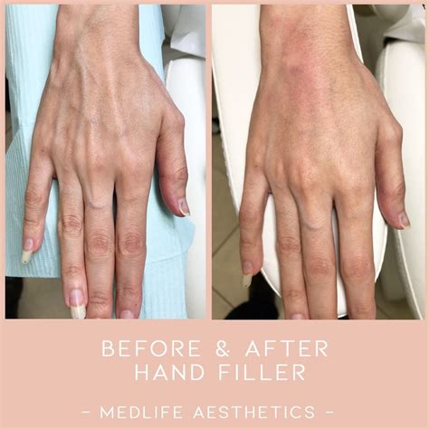 Hand filler | Esthetics, Plastic surgery, Filler