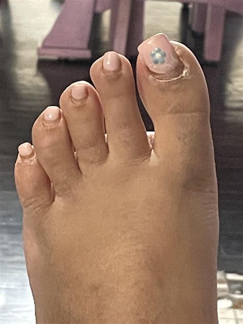 Why Are My Toenails Growing Sideways? Find Solutions - Fury Things